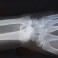 Unsplash - broken bone